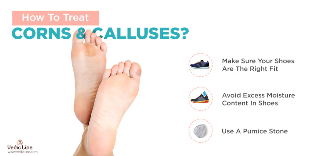How to treat corns and calluses- Vedicline