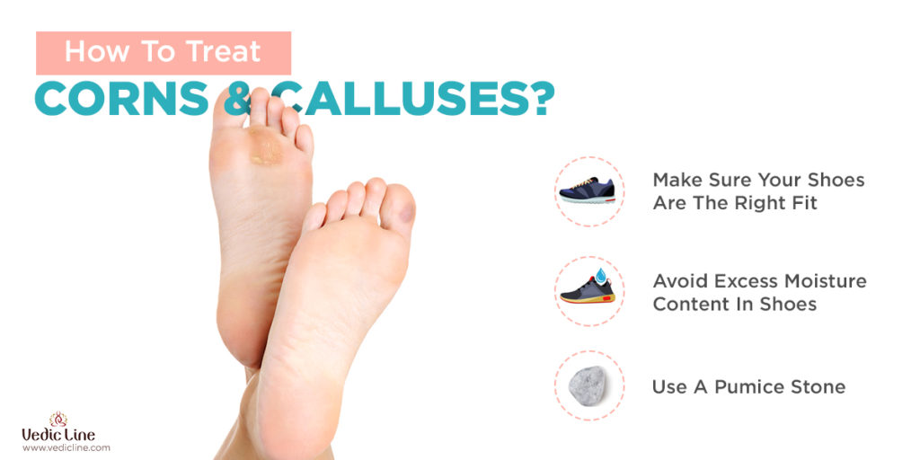 5 Tips to Prevent Calluses and Corns on Toes and Heels - Organic Authority