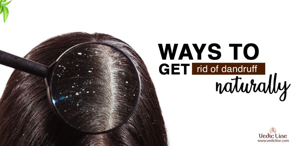 Ways to get rid of Dandruff Naturally