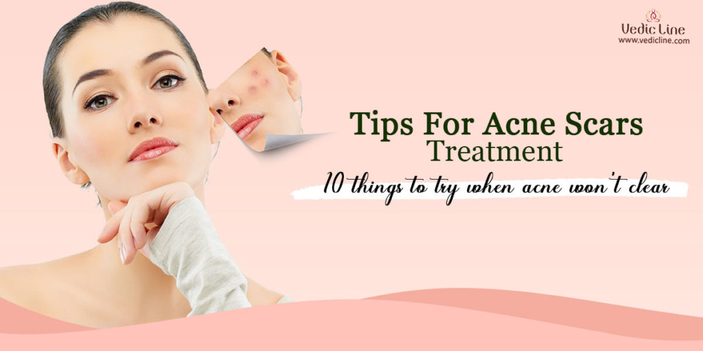 Tips for acne and scars-Vedicline