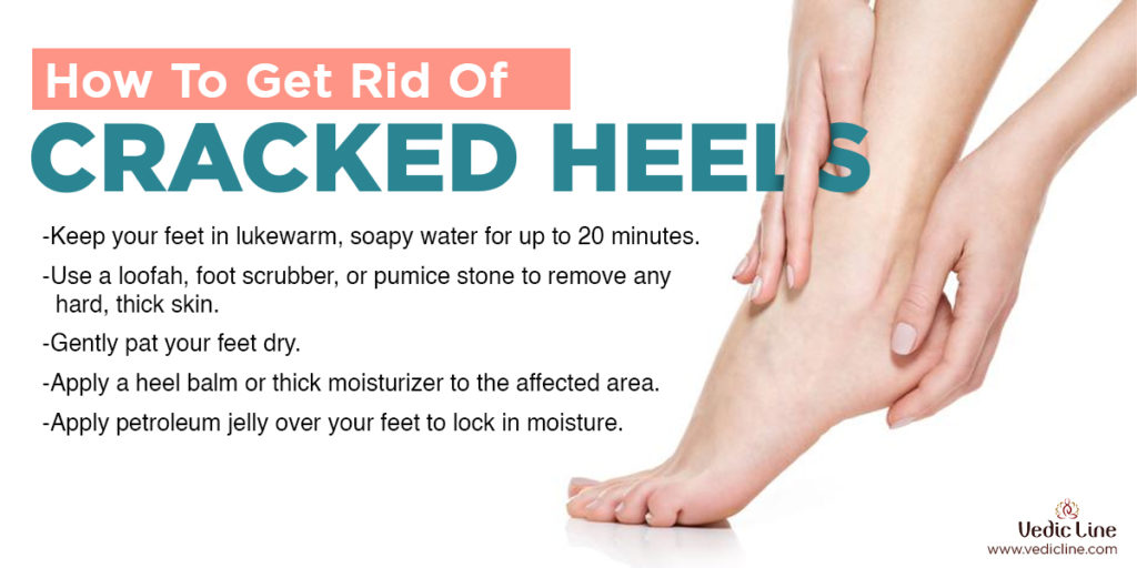 Most important foot care tips: How to get rid of cracked heels