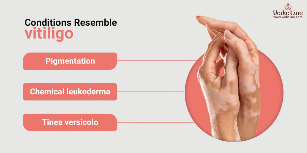 causes of vitiligo