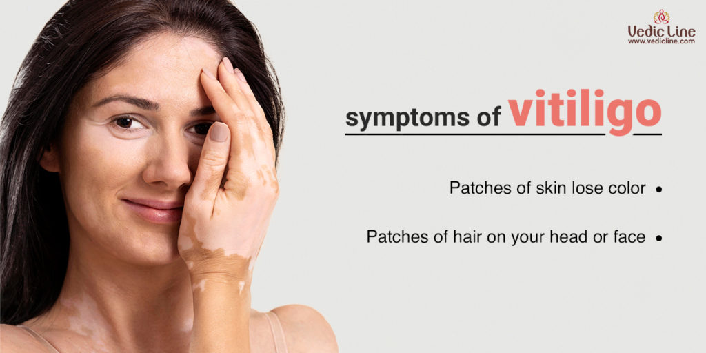 Symptoms of vitiligo