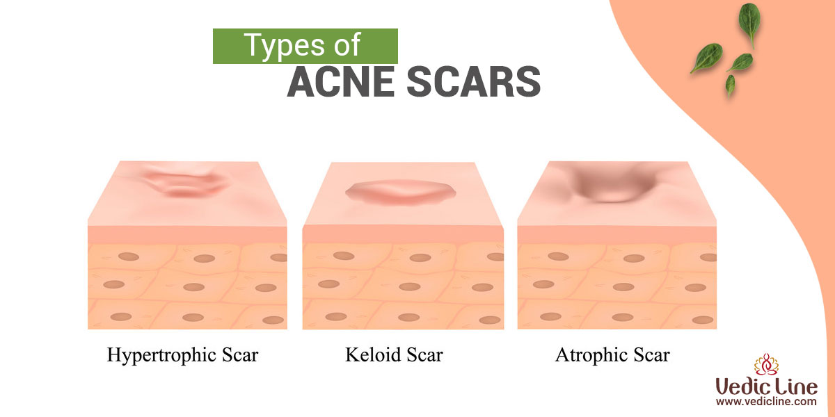 Everything You Wanted to Know About Acne: And Were Afraid To Ask ...