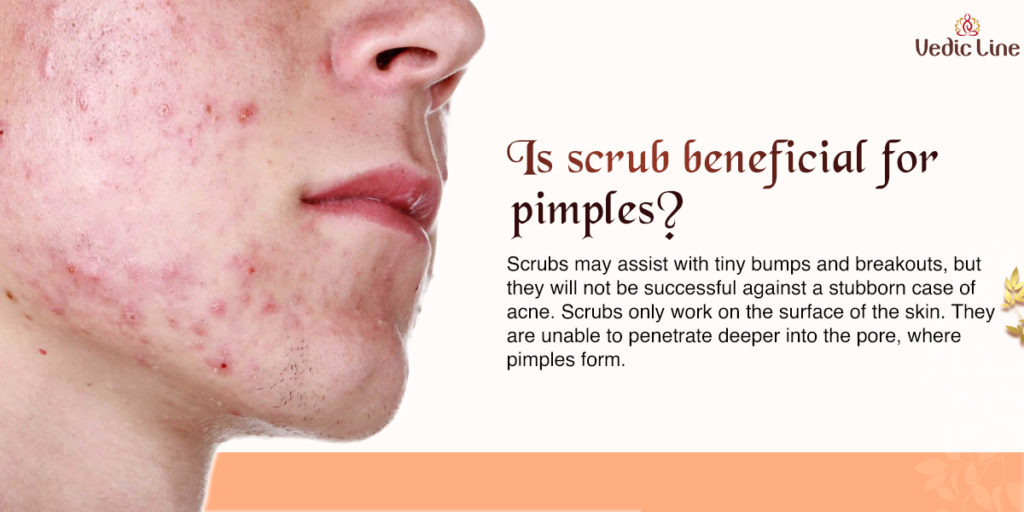 scrub-for-pimple