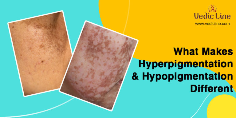 What Makes Hyperpigmentation And Hypopigmentation Different - Vedicline