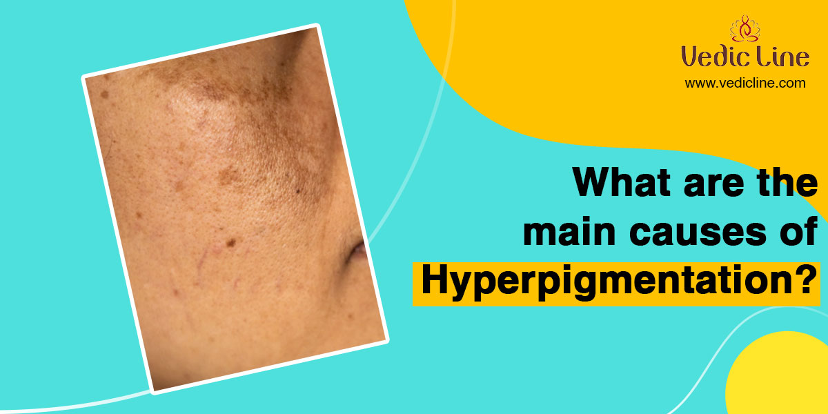 What Makes Hyperpigmentation and Hypopigmentation Different Vedicline